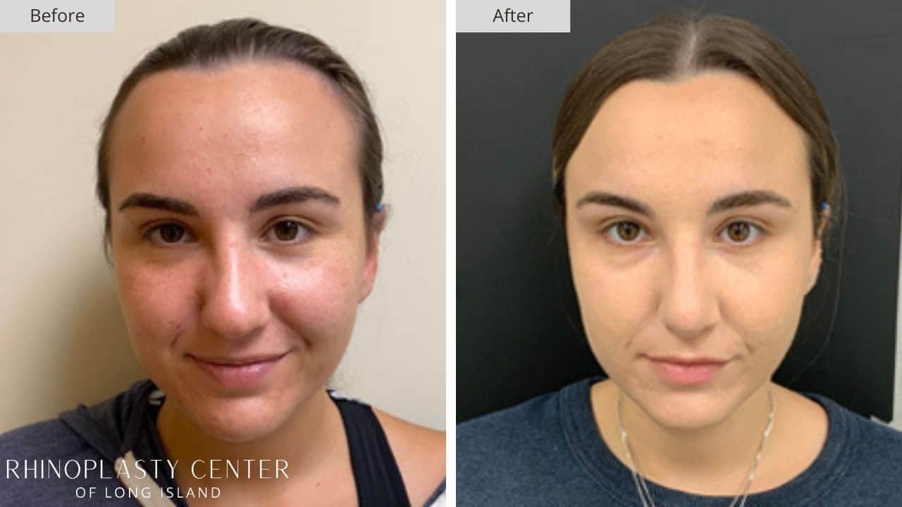 Rhinoplasty Long Island Before and After Photo 32b