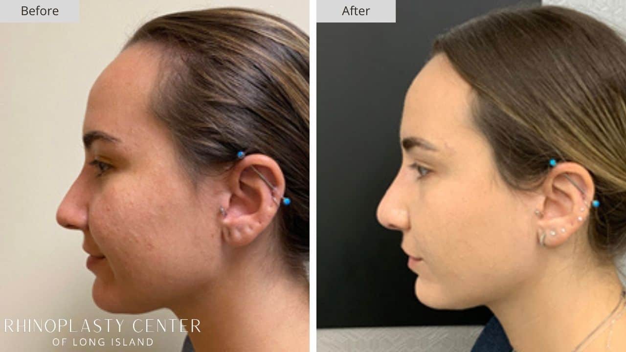 Rhinoplasty Long Island Before and After Photo 32c