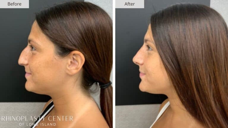 Rhinoplasty Long Island Before and After Photo 33a
