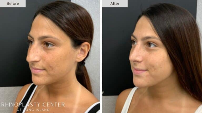 Rhinoplasty Long Island Before and After Photo 33b