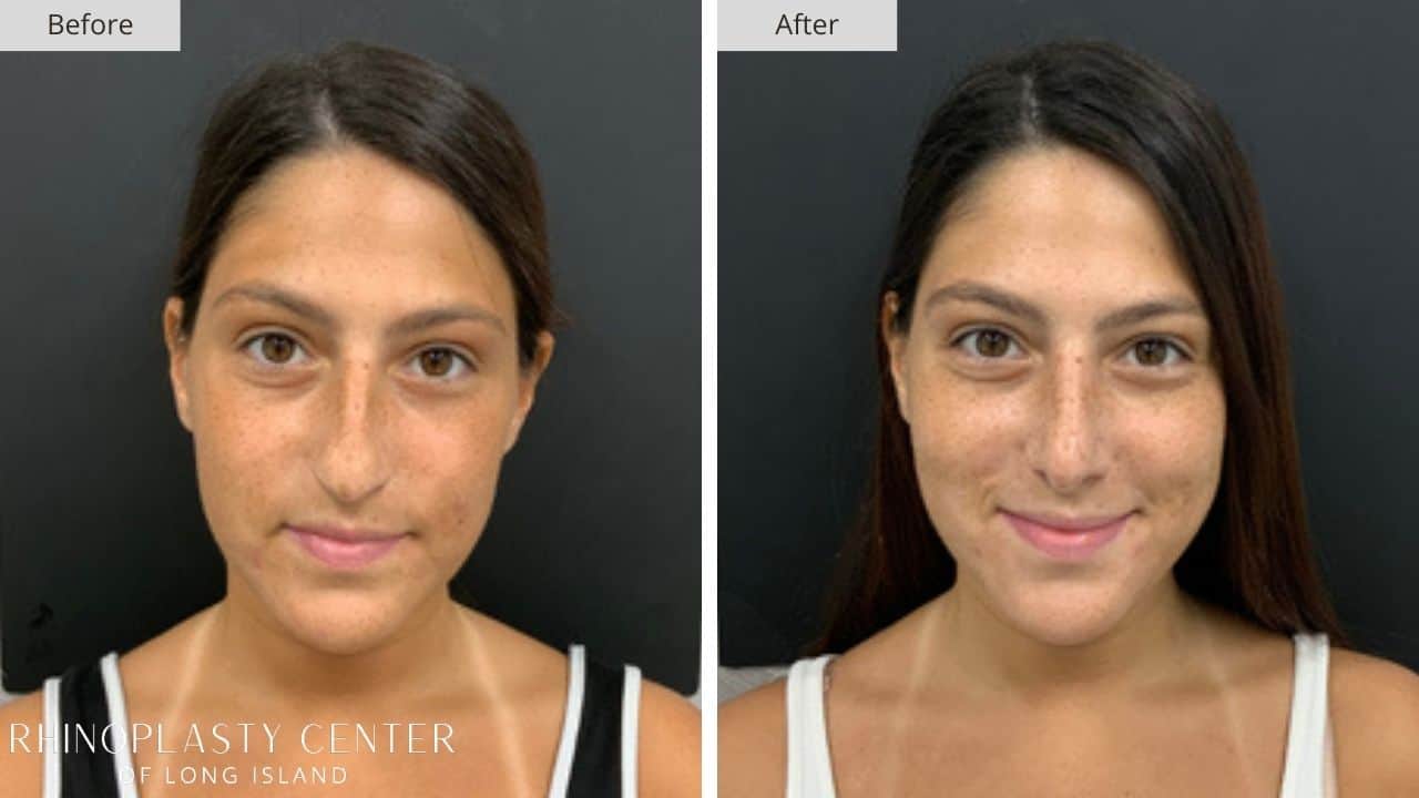 Rhinoplasty Long Island Before and After Photo 33c