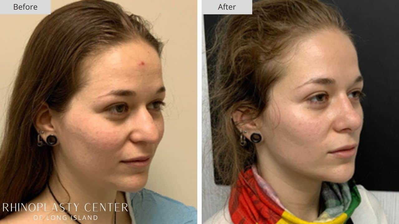 Rhinoplasty Long Island Before and After Photo 34a