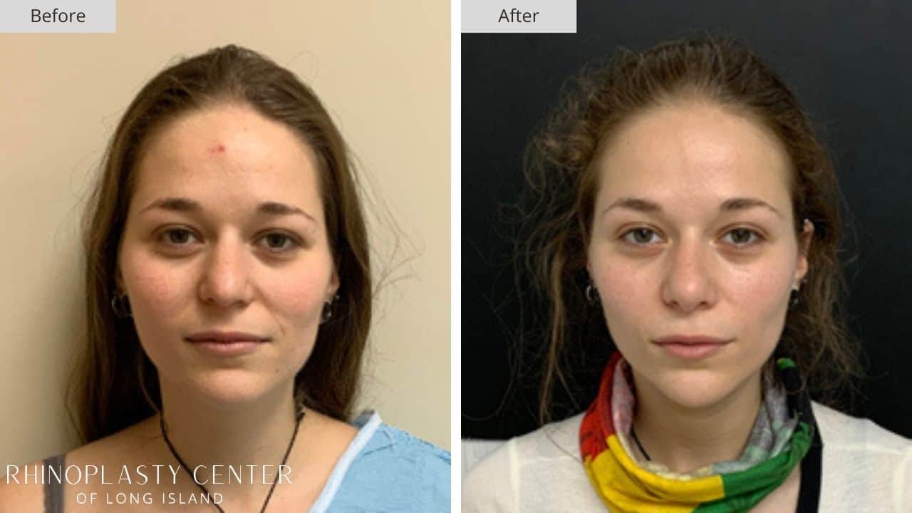 Rhinoplasty Long Island Before and After Photo 34b