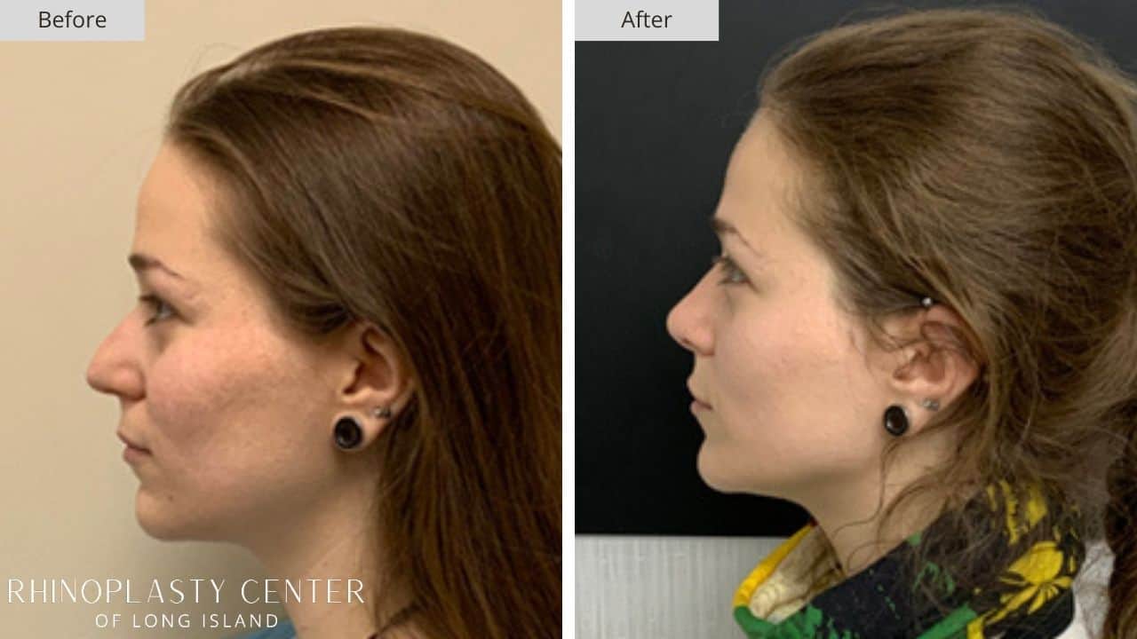 Rhinoplasty Long Island Before and After Photo 34c
