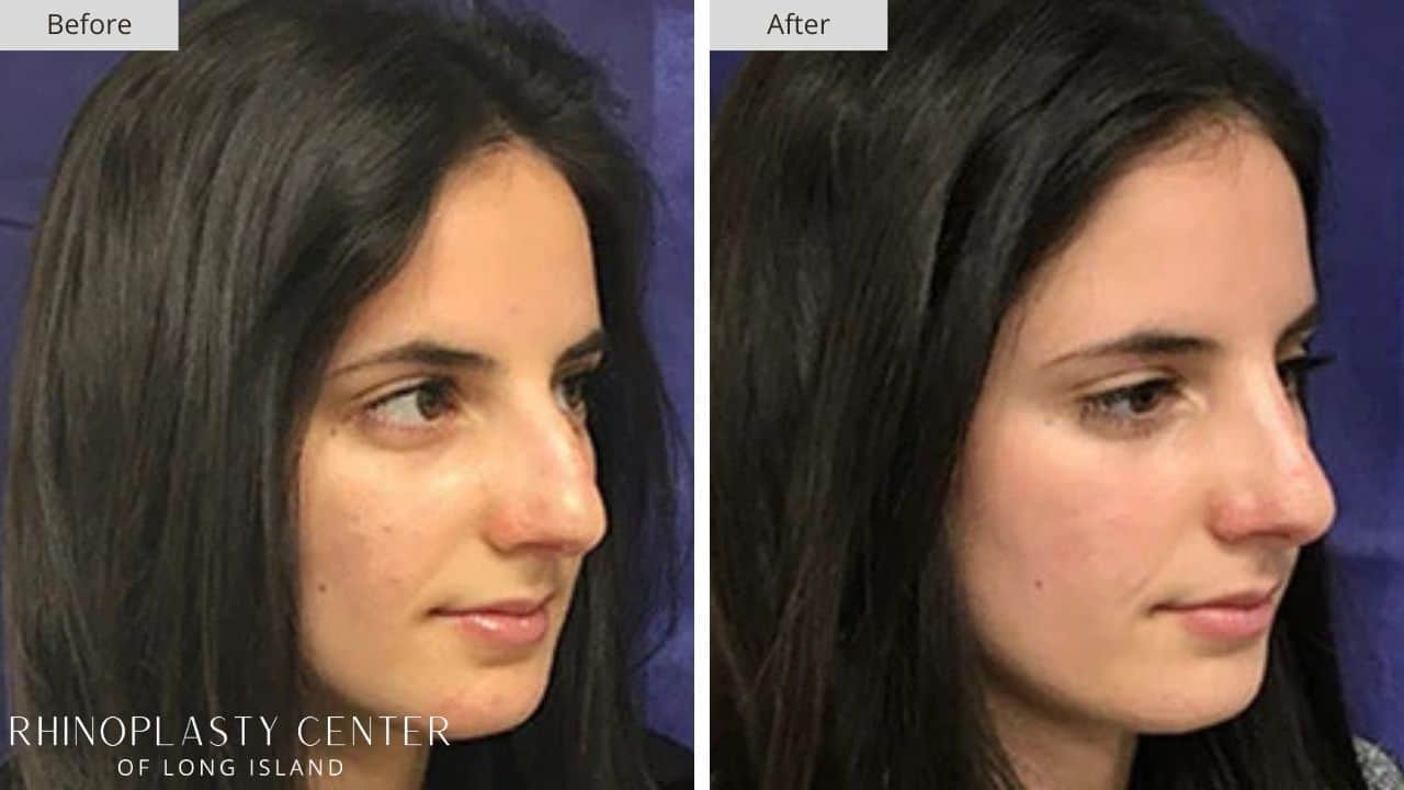 Rhinoplasty Long Island Before and After Photo 35a