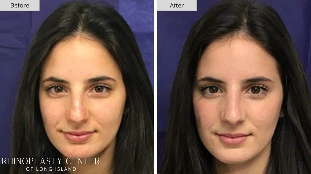 Rhinoplasty Long Island Before and After Photo 35b