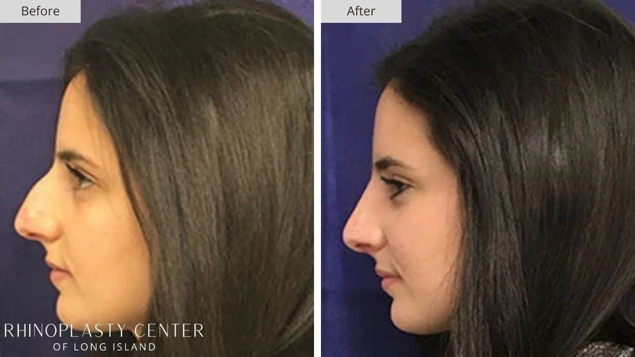 Rhinoplasty Long Island Before and After Photo 35c