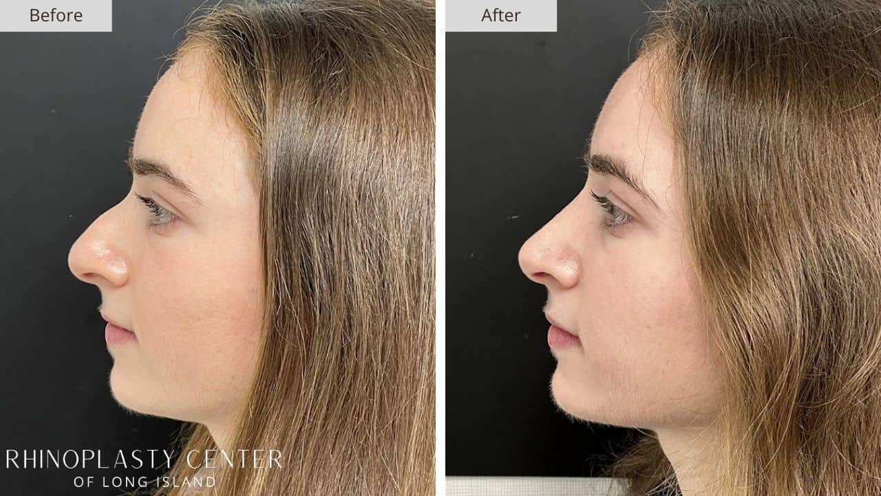 Rhinoplasty Long Island Before and After Photo 36a