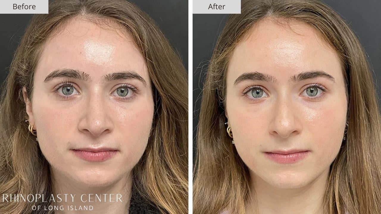 Rhinoplasty Long Island Before and After Photo 36b