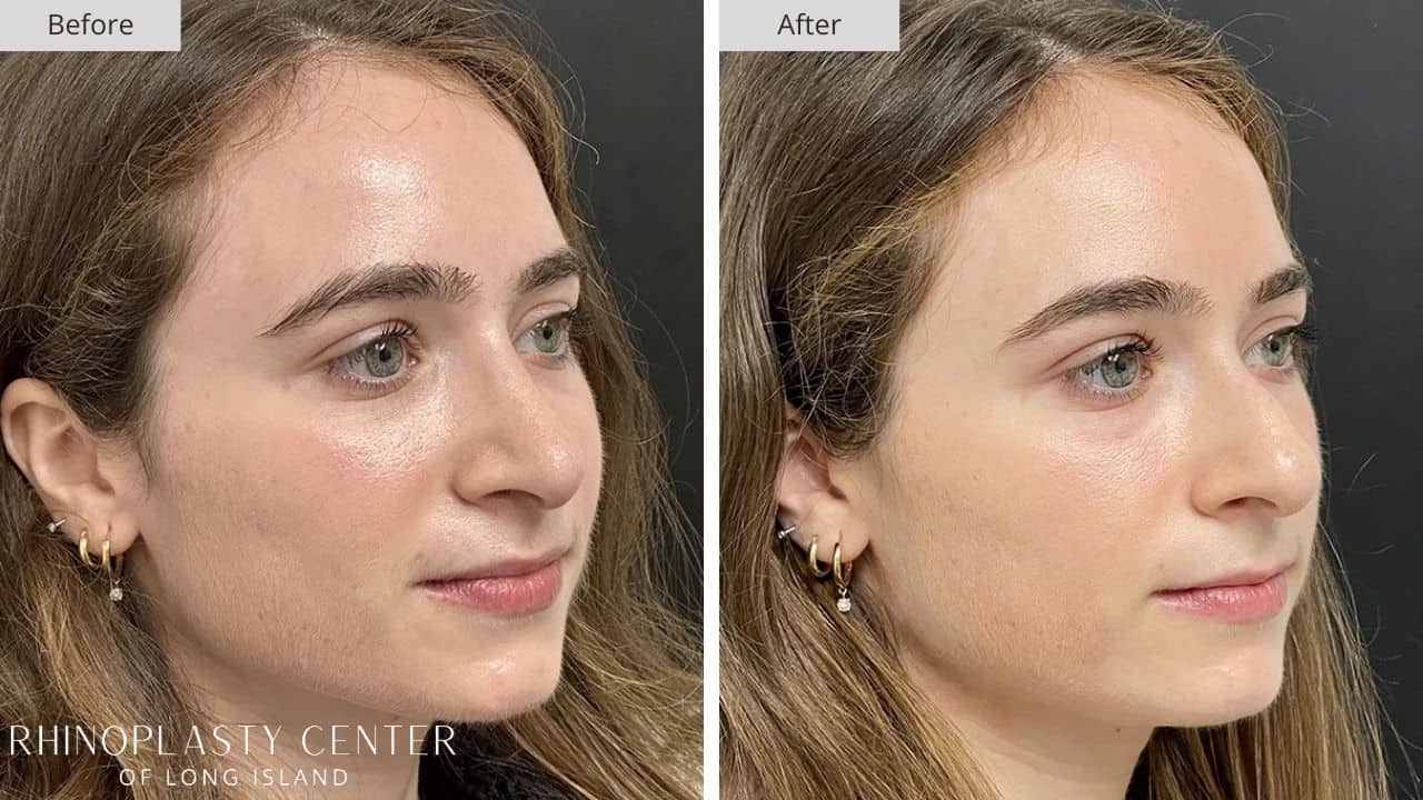 Rhinoplasty Long Island Before and After Photo 36c