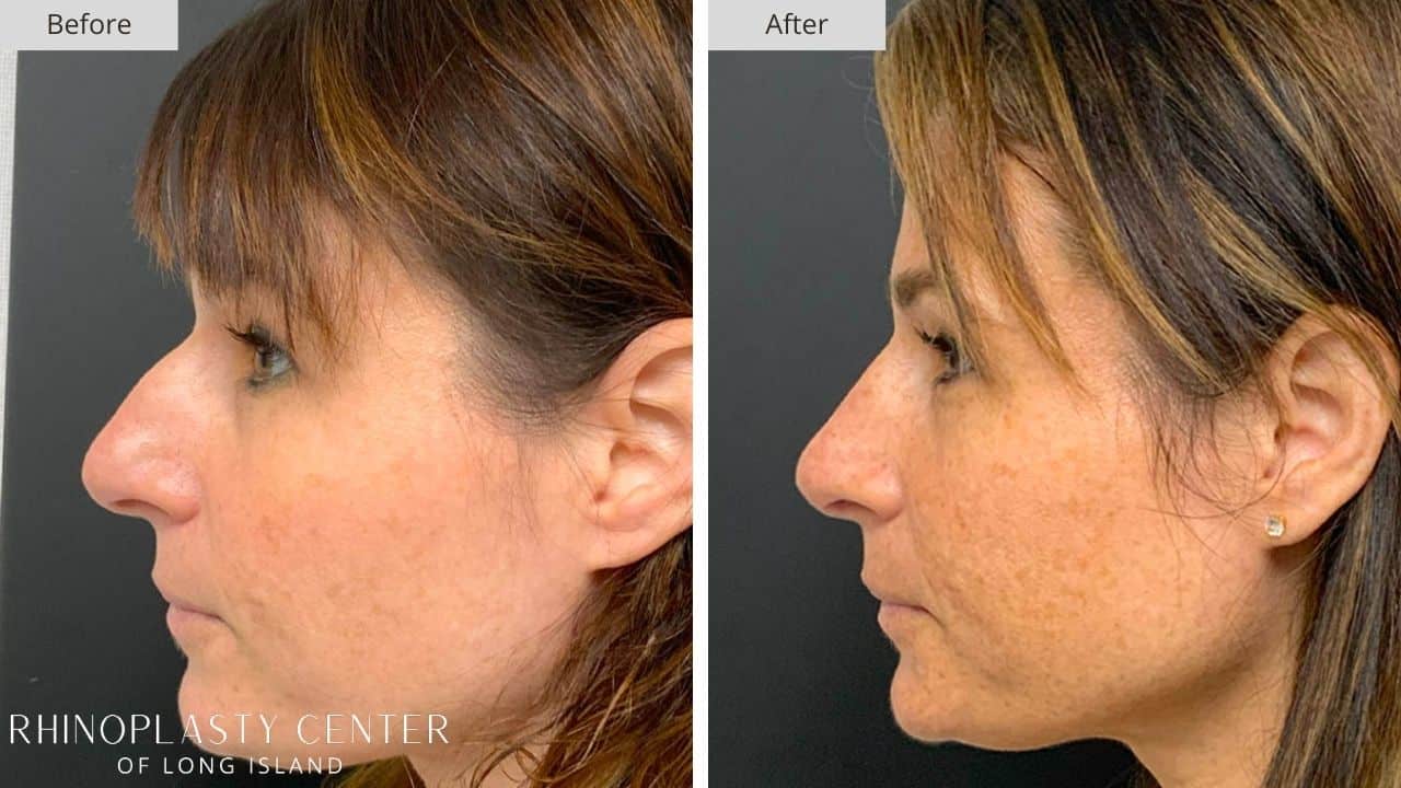 Rhinoplasty Long Island Before and After Photo 3a