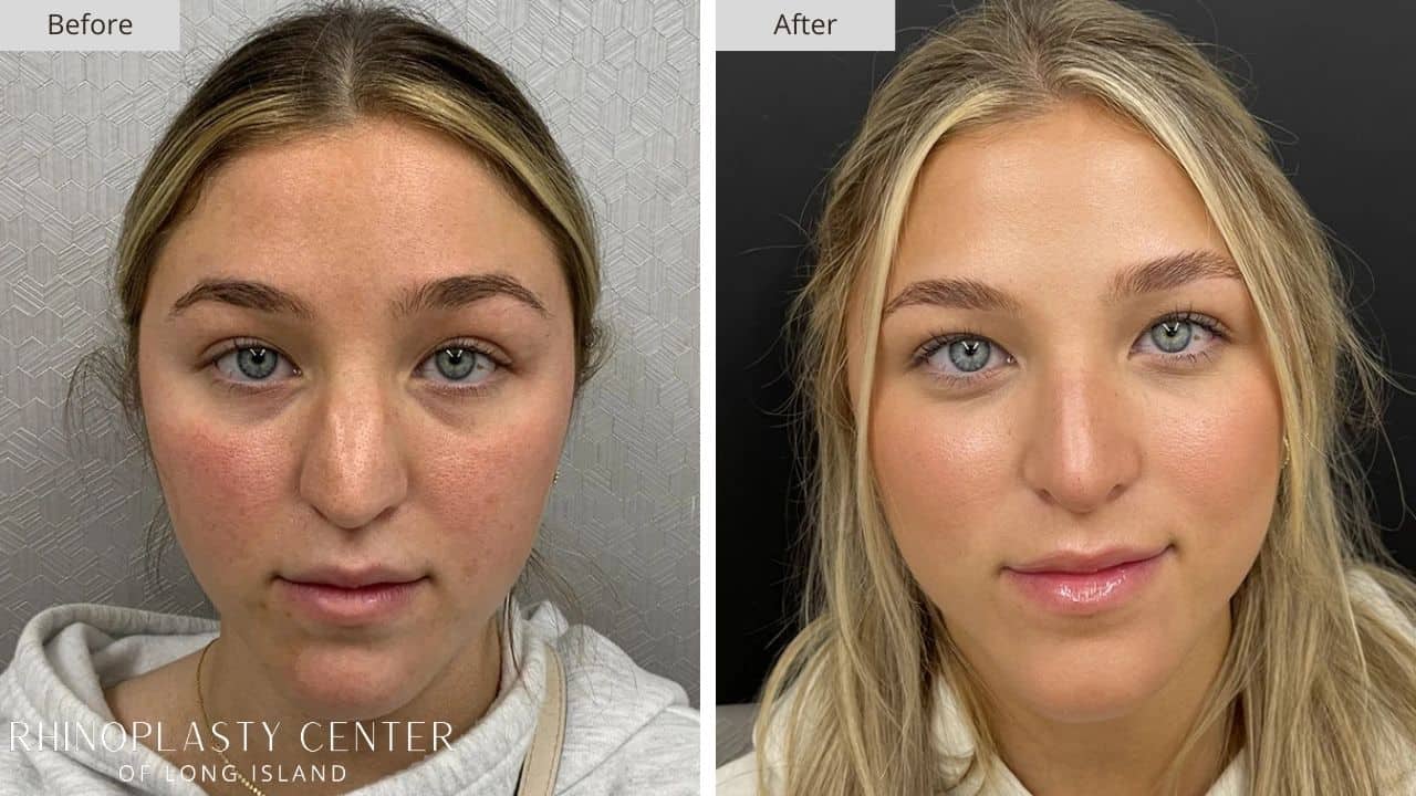 Rhinoplasty Long Island Before and After Photo 40a