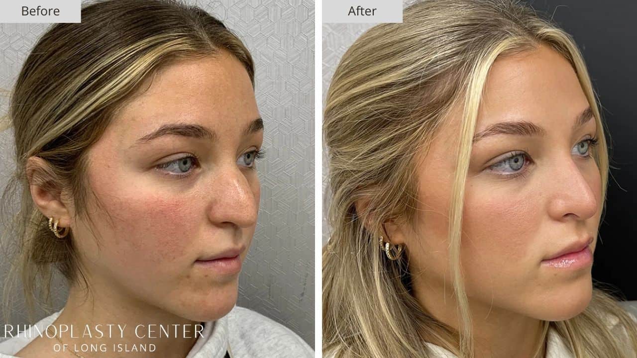 Rhinoplasty Long Island Before and After Photo 40b