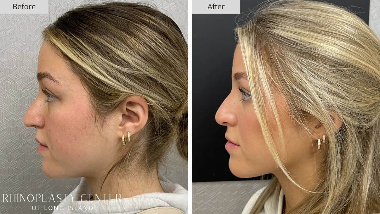 Rhinoplasty Long Island Before and After Photo 40c