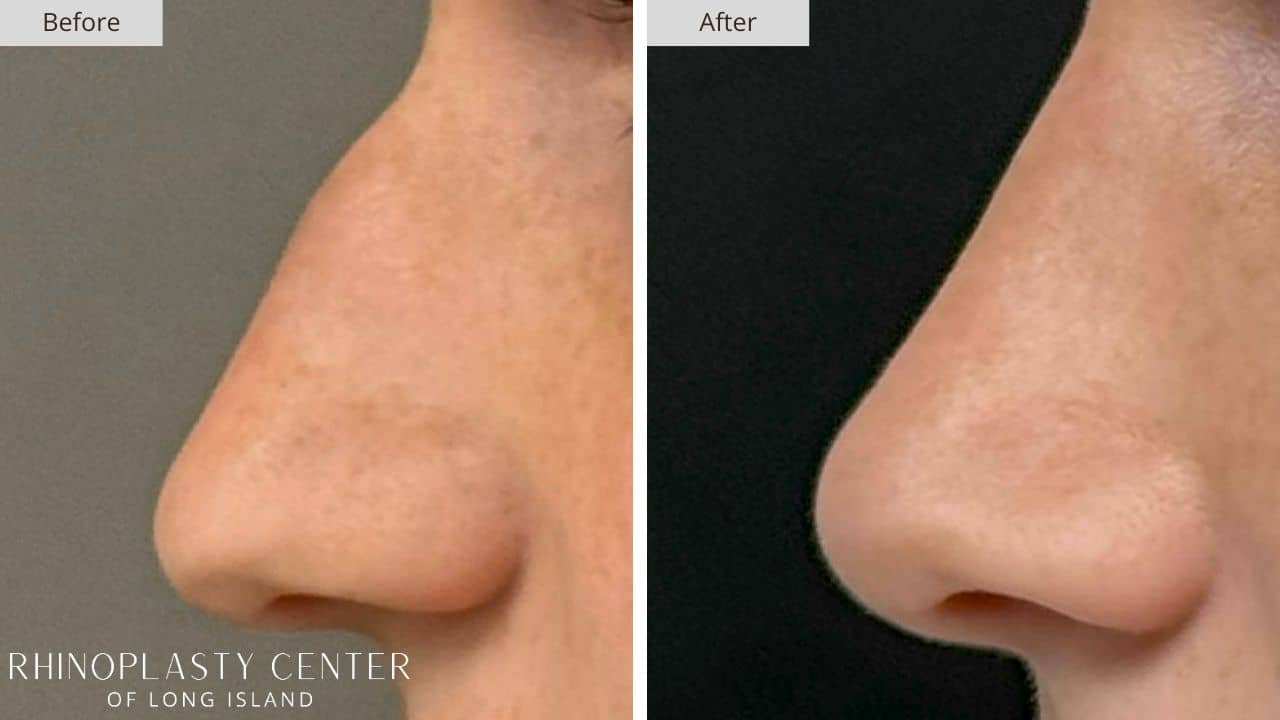 Rhinoplasty Long Island Before and After Photo 4a
