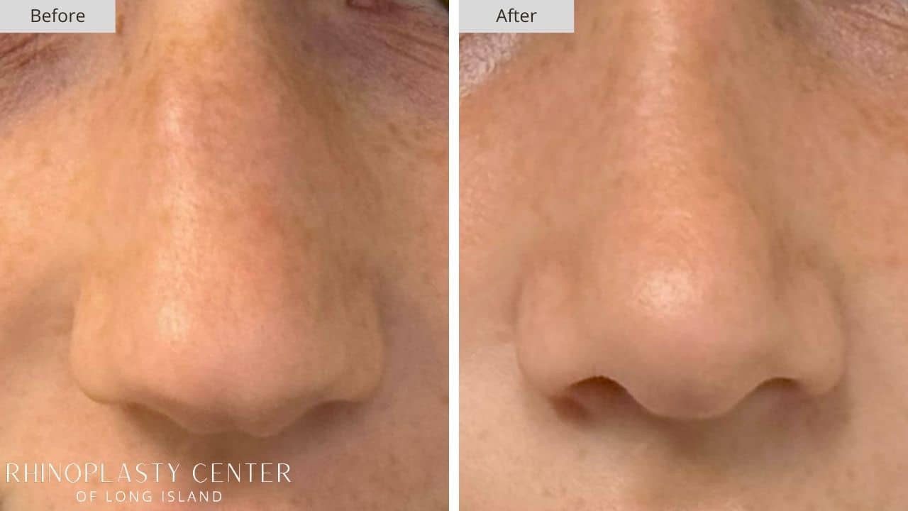 Rhinoplasty Long Island Before and After Photo 4b
