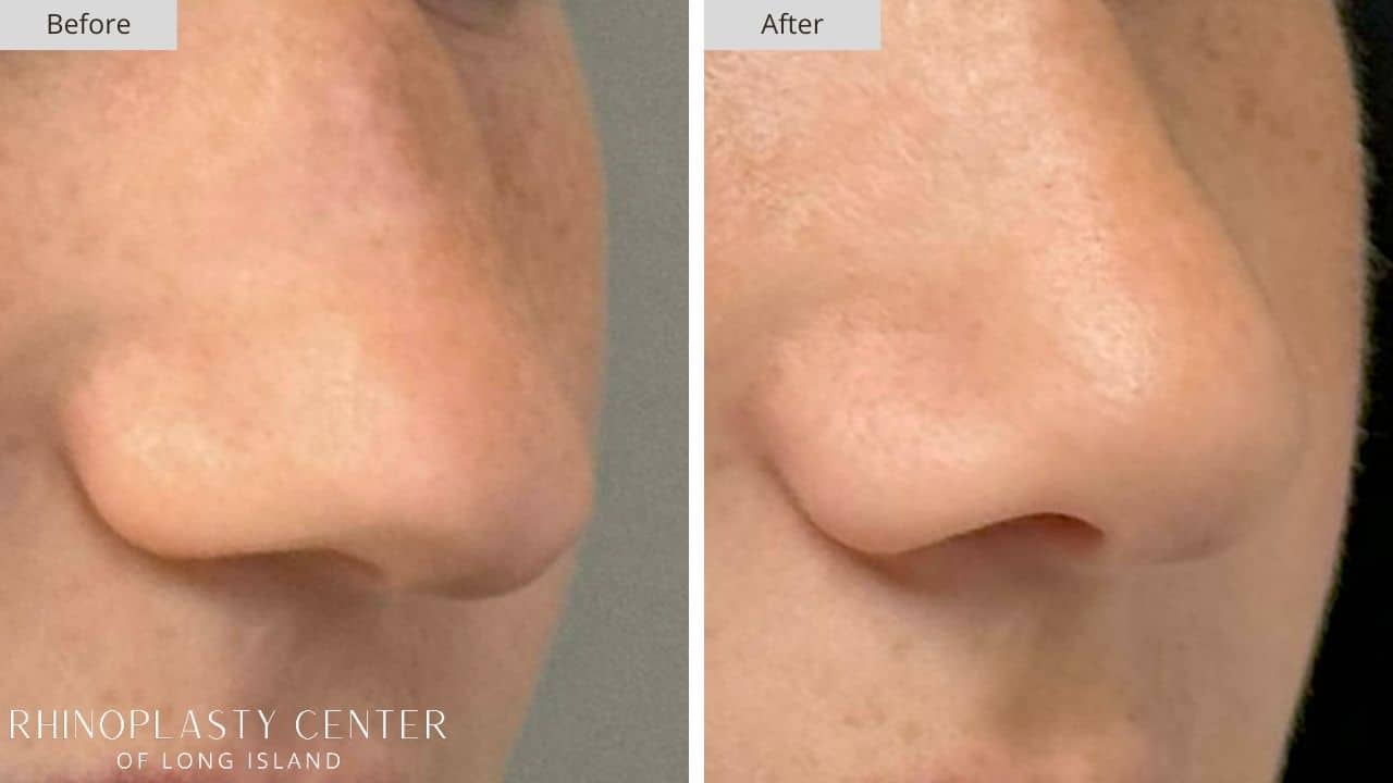 Rhinoplasty Long Island Before and After Photo 4c