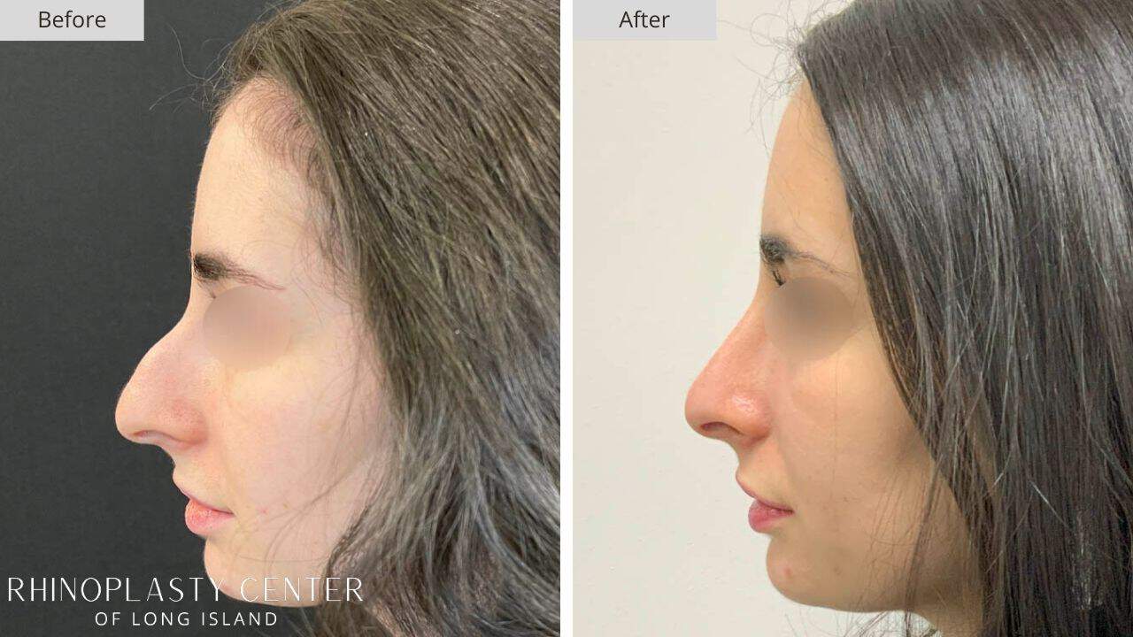 Rhinoplasty Long Island Before and After Photo 5a