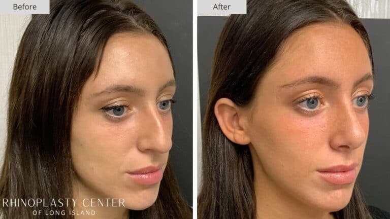 Rhinoplasty Long Island Before and After Photo 66a
