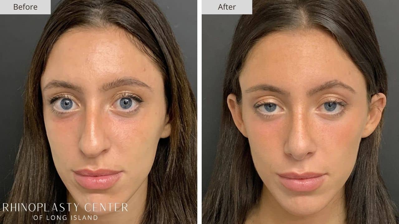 Rhinoplasty Long Island Before and After Photo 66b