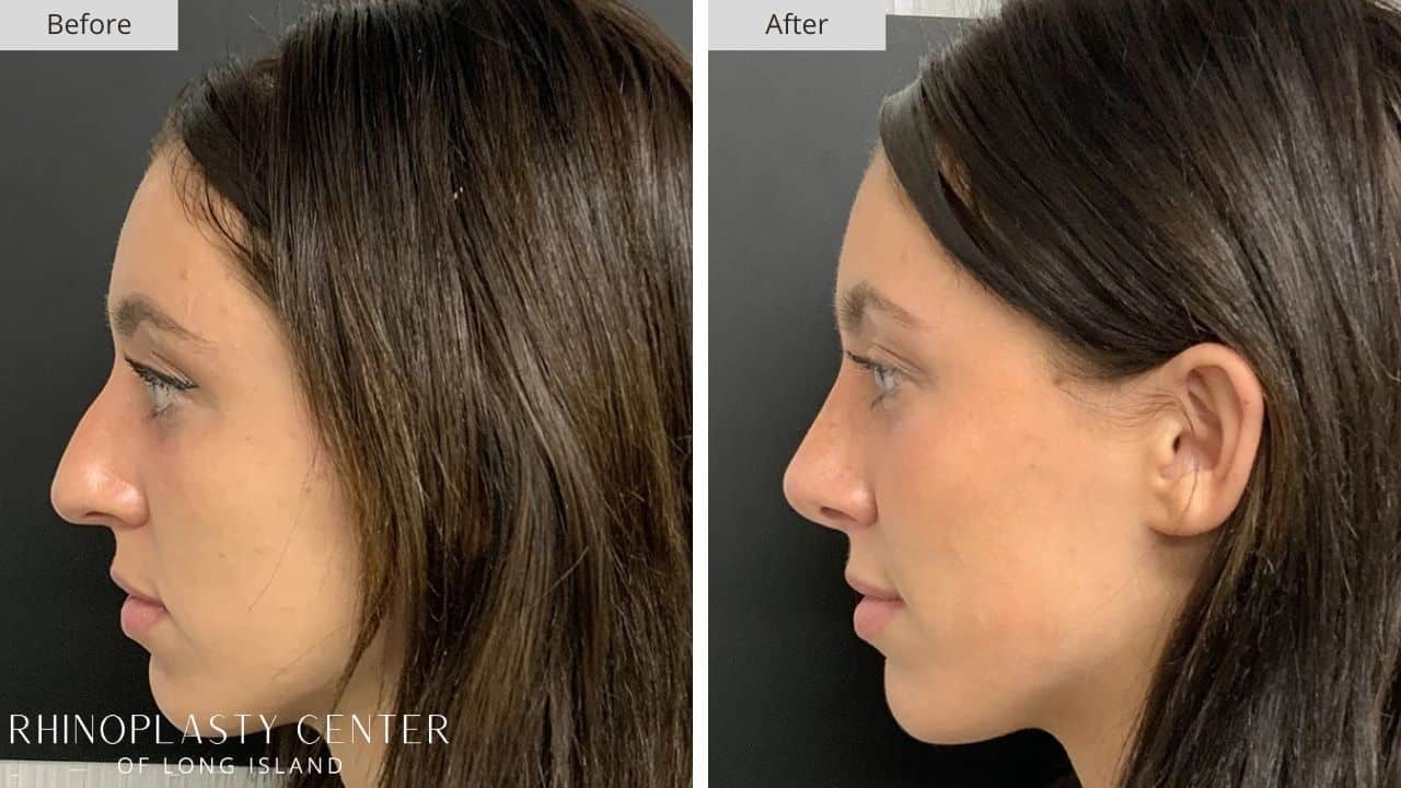 Rhinoplasty Long Island Before and After Photo 66c