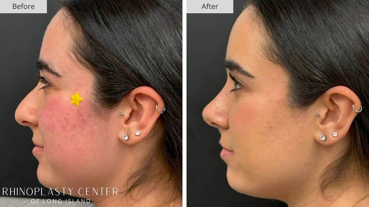 Rhinoplasty Long Island Before and After Photo 6a