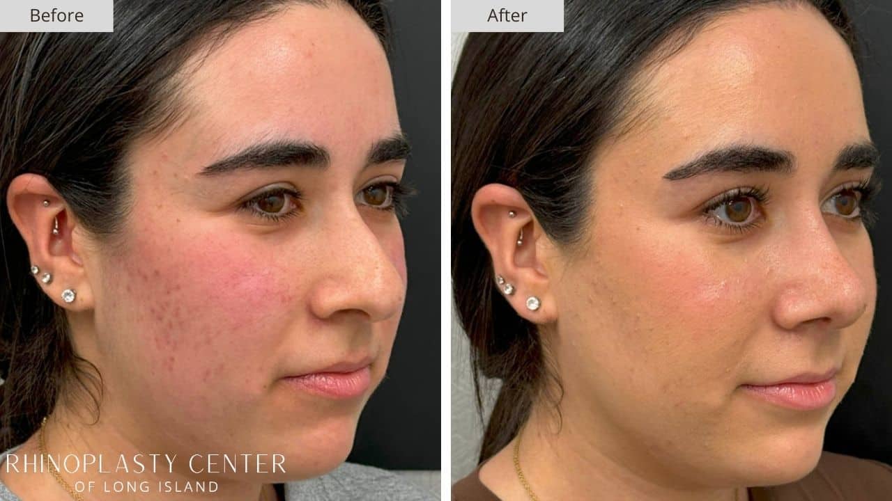 Rhinoplasty Long Island Before and After Photo 6b