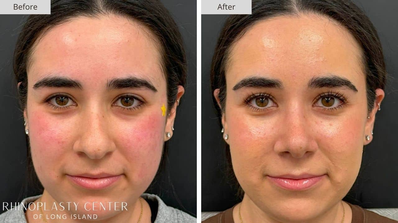 Rhinoplasty Long Island Before and After Photo 6c