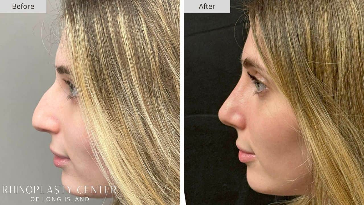 Rhinoplasty Long Island Before and After Photo 7a