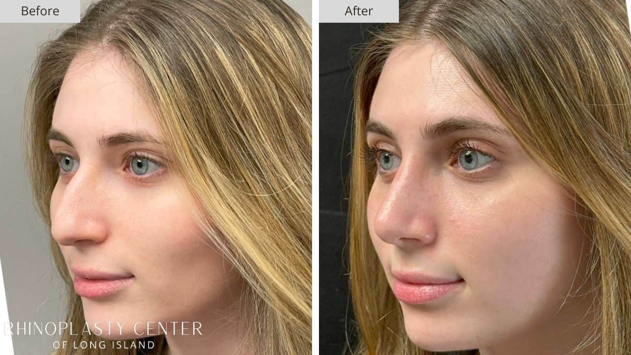 Rhinoplasty Long Island Before and After Photo 7b