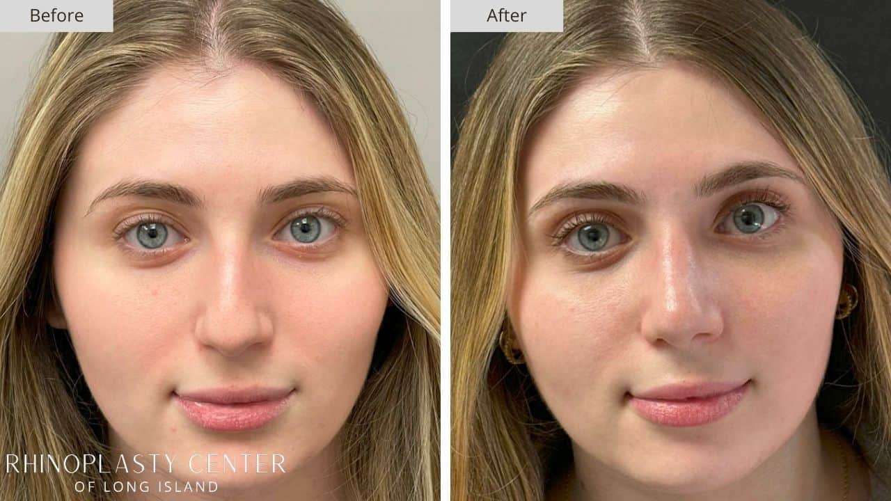 Rhinoplasty Long Island Before and After Photo 7c