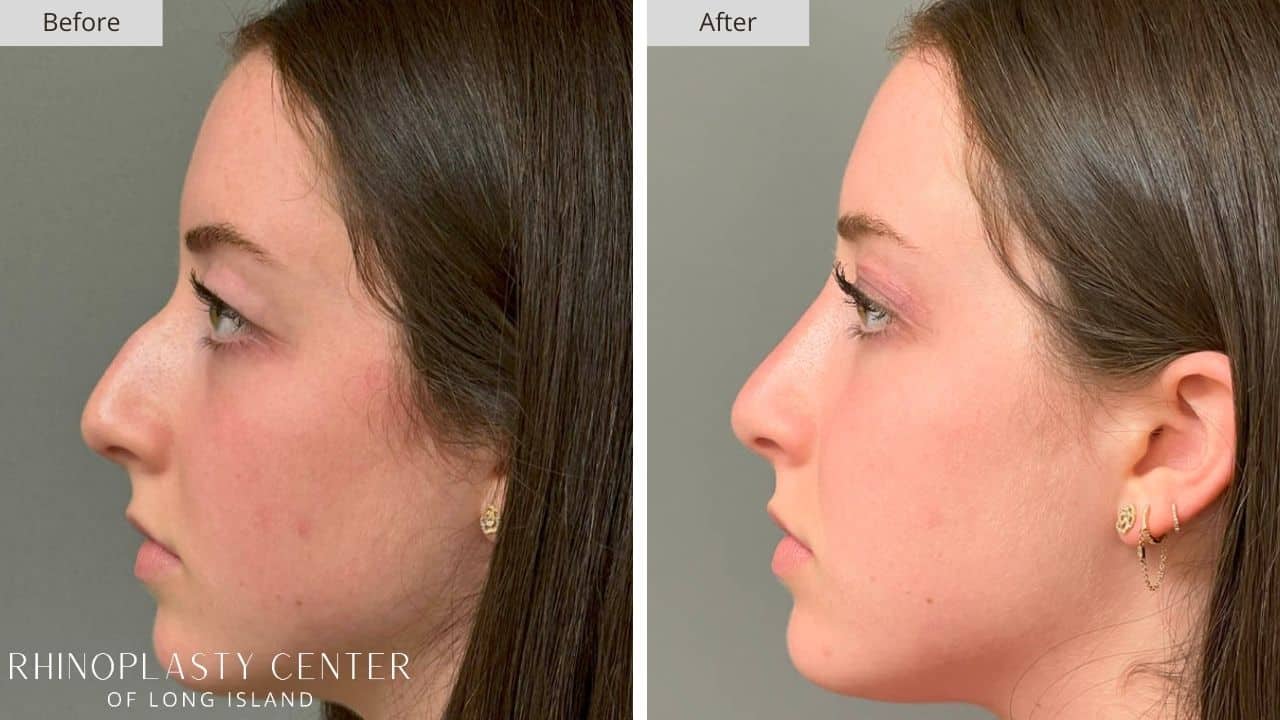 Rhinoplasty Long Island Before and After Photo 8a