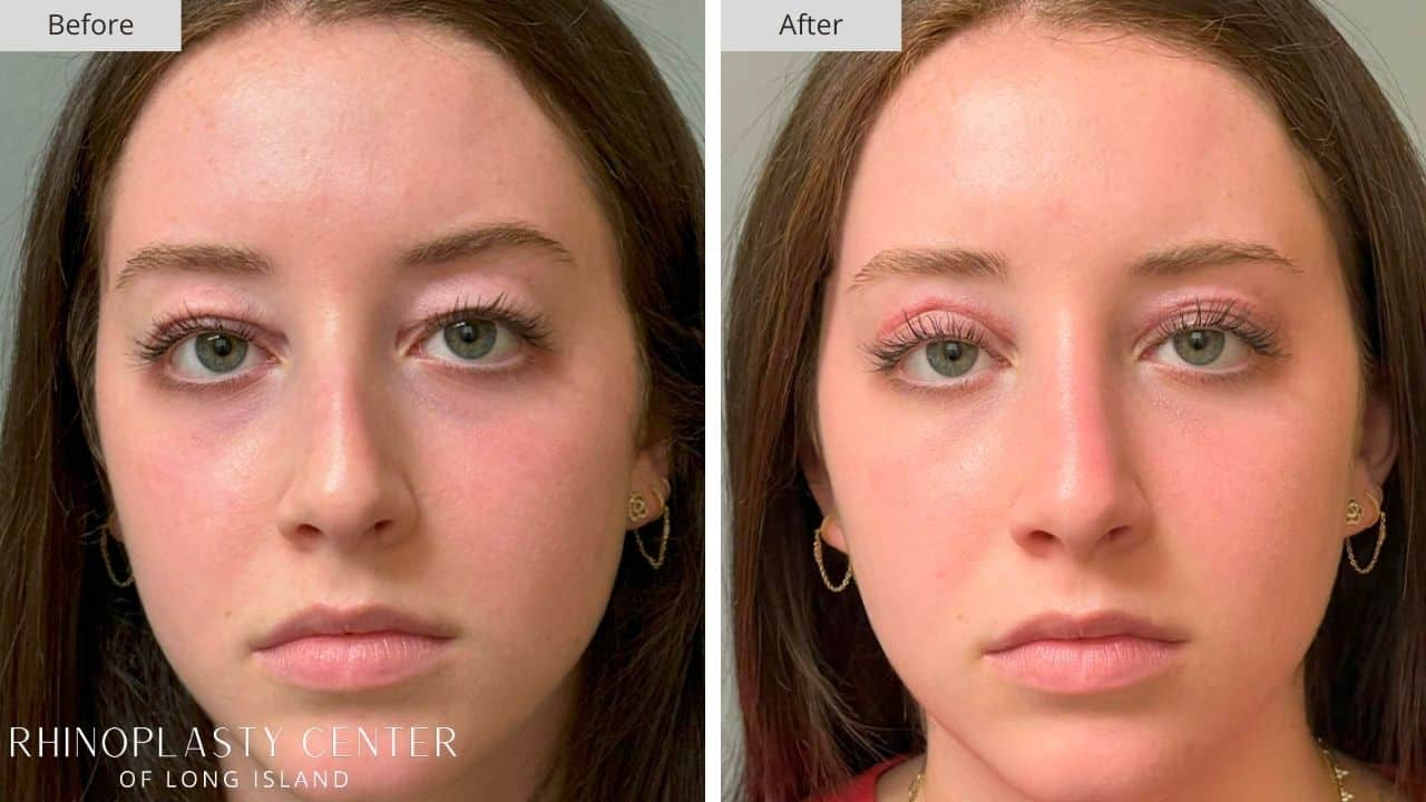 Rhinoplasty Long Island Before and After Photo 8b