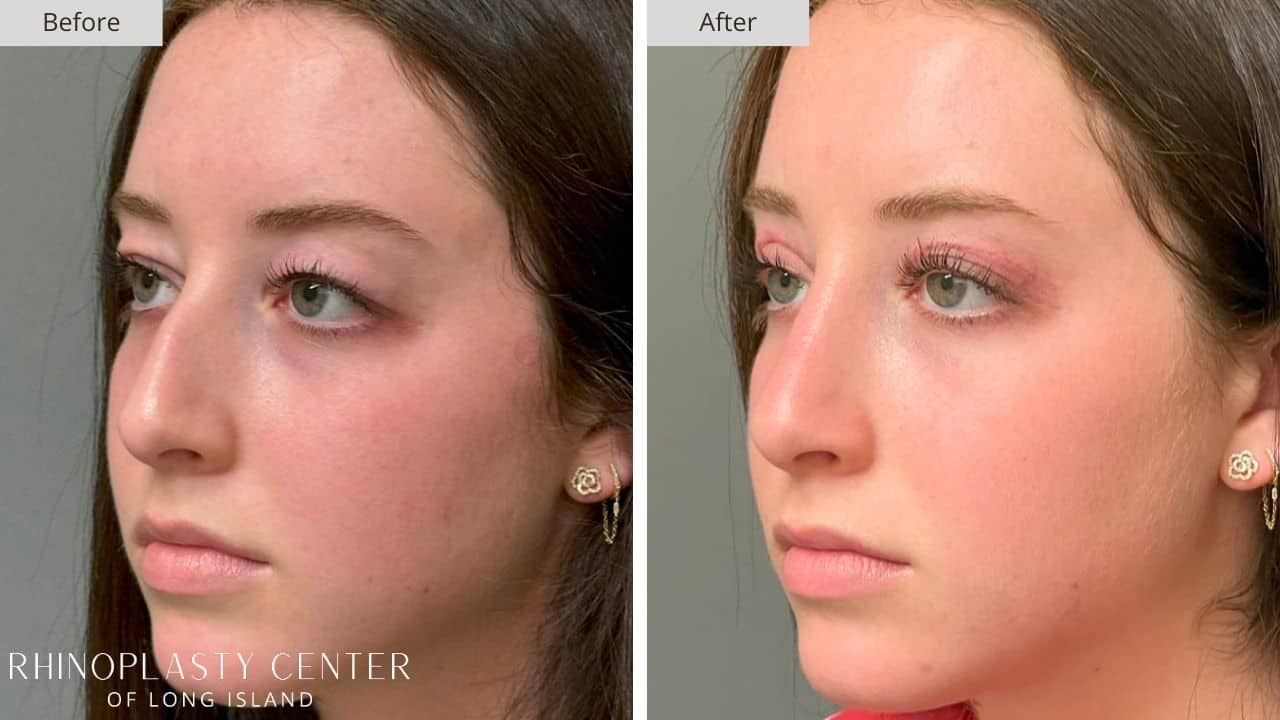 Rhinoplasty Long Island Before and After Photo 8c
