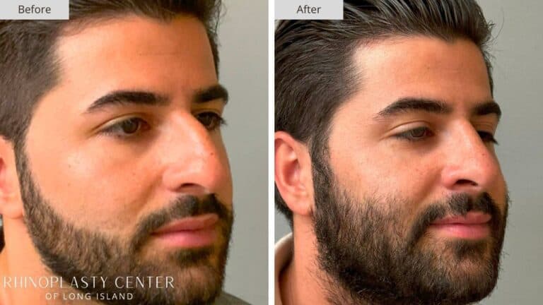 Rhinoplasty Long Island Before and After Photo 9a