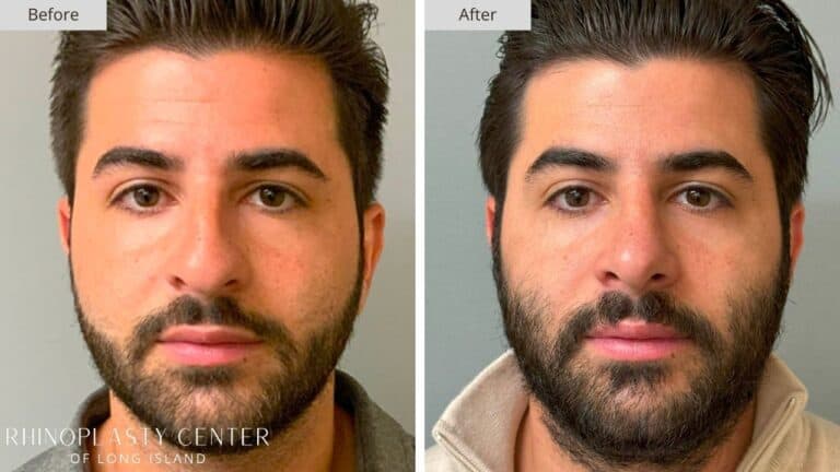 Rhinoplasty Long Island Before and After Photo 9b