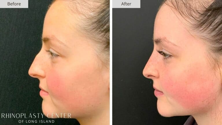 Rhinoplasty Long Island Before and After Photo Patient