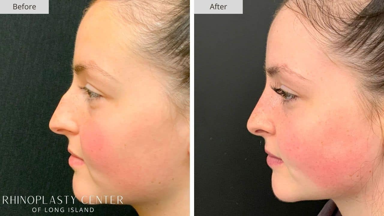 Rhinoplasty Long Island Before and After Photo Patient