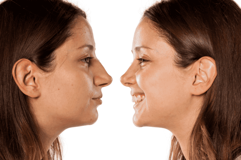 rhinoplasty creates confidence