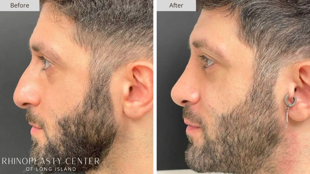 Rhinoplasty Center of Long Island Before and After Patient 201a