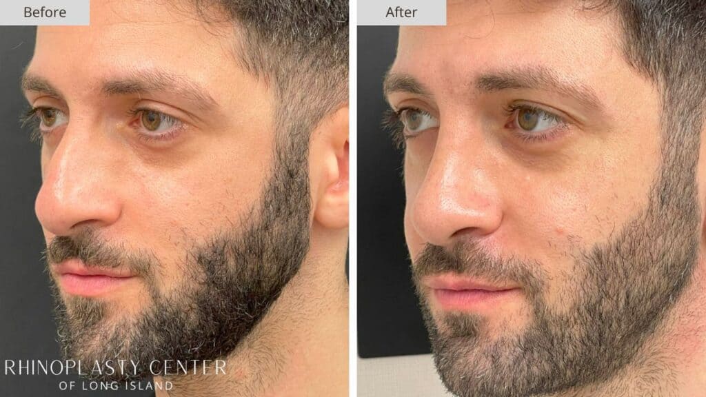 Rhinoplasty Center of Long Island Before and After Patient 201b