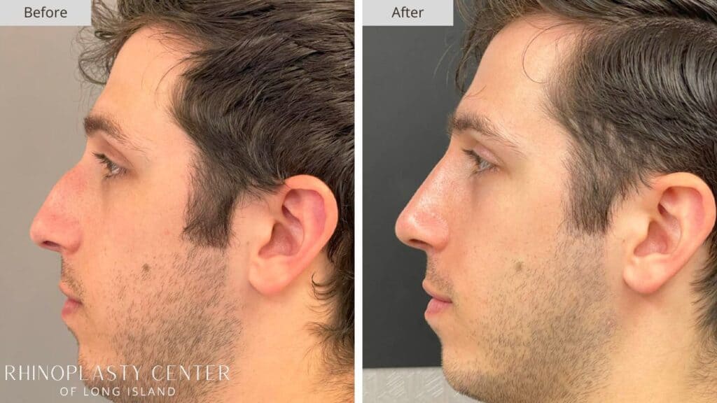 Rhinoplasty Center of Long Island Before and After Patient 202a