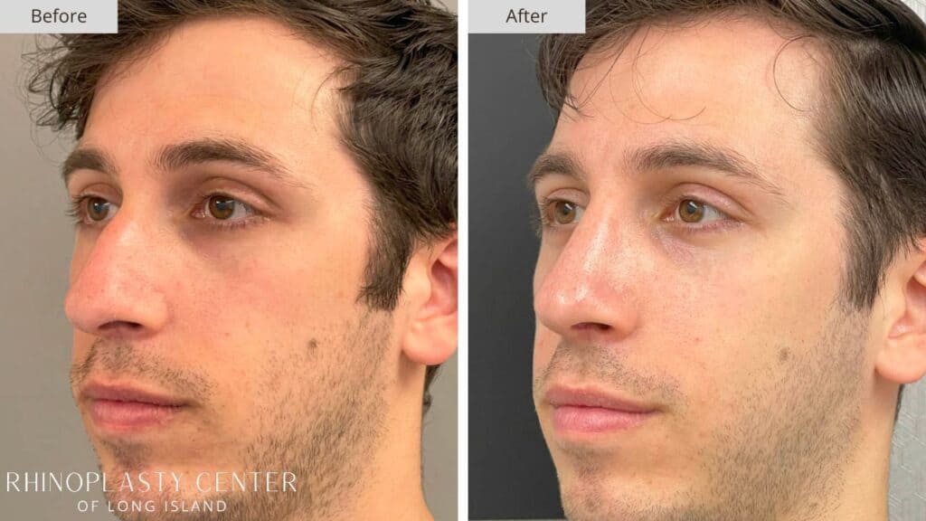 Rhinoplasty Center of Long Island Before and After Patient 202b