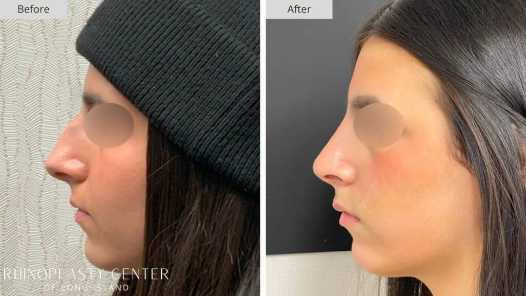 Rhinoplasty Center of Long Island Before and After Patient 203a