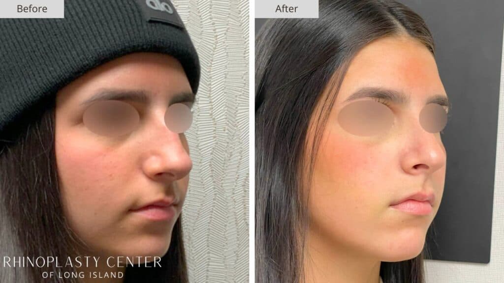 Rhinoplasty Center of Long Island Before and After Patient 203b