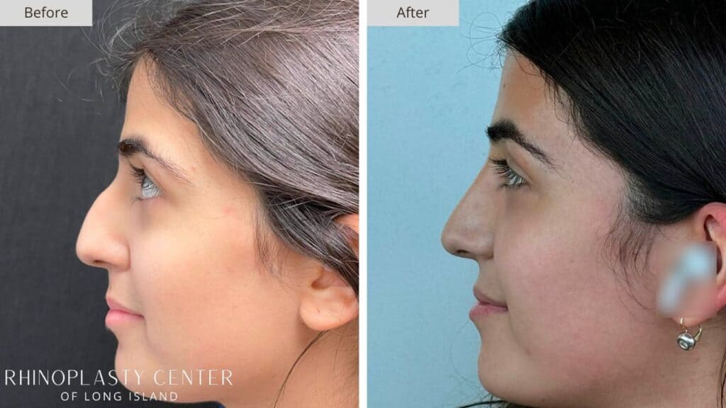 Rhinoplasty Center of Long Island Before and After Patient 204a