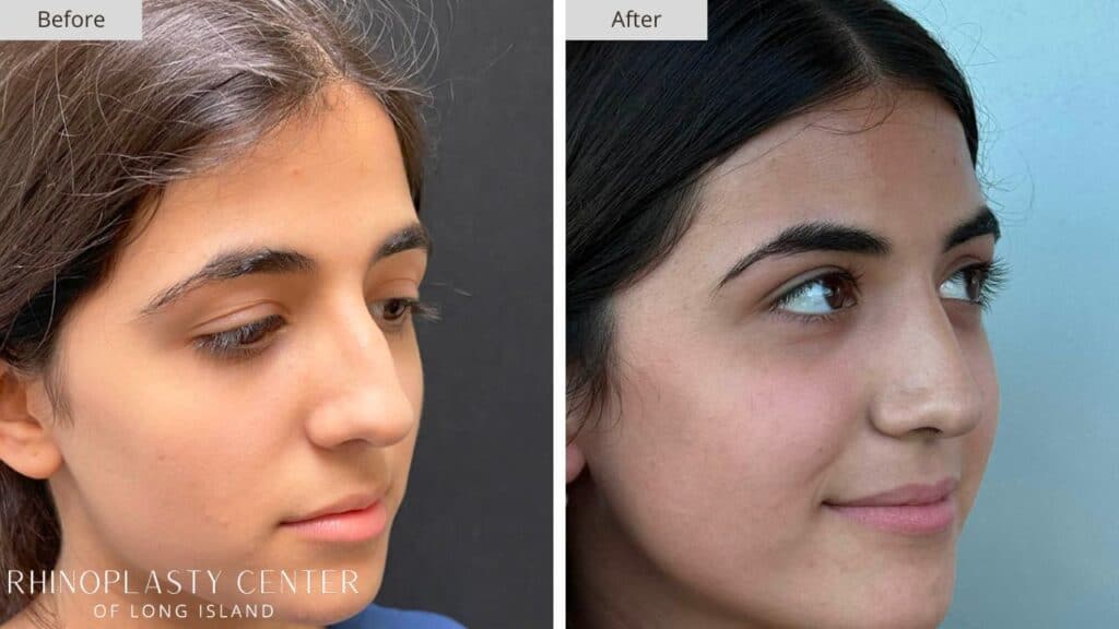 Rhinoplasty Center of Long Island Before and After Patient 204b