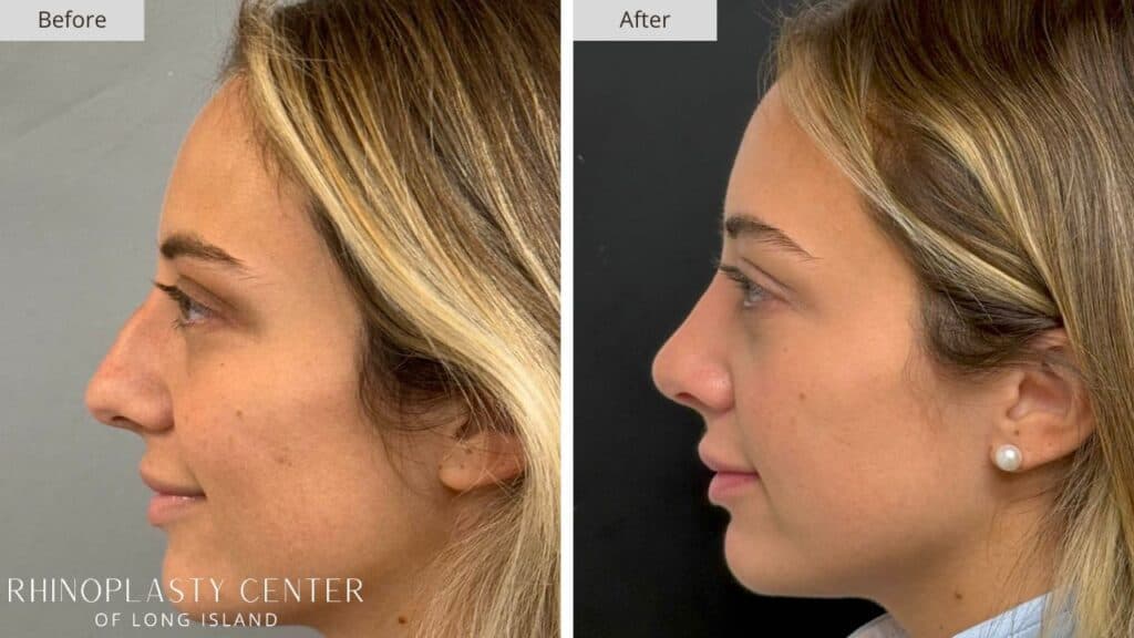 Rhinoplasty Center of Long Island Before and After Patient 205a
