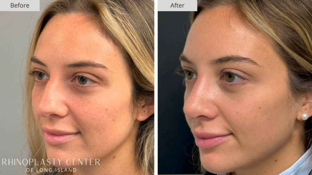 Rhinoplasty Center of Long Island Before and After Patient 205b