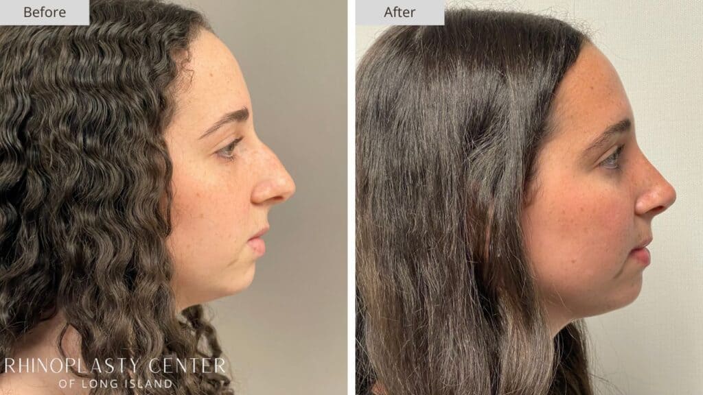 Rhinoplasty Center of Long Island Before and After Patient 206a